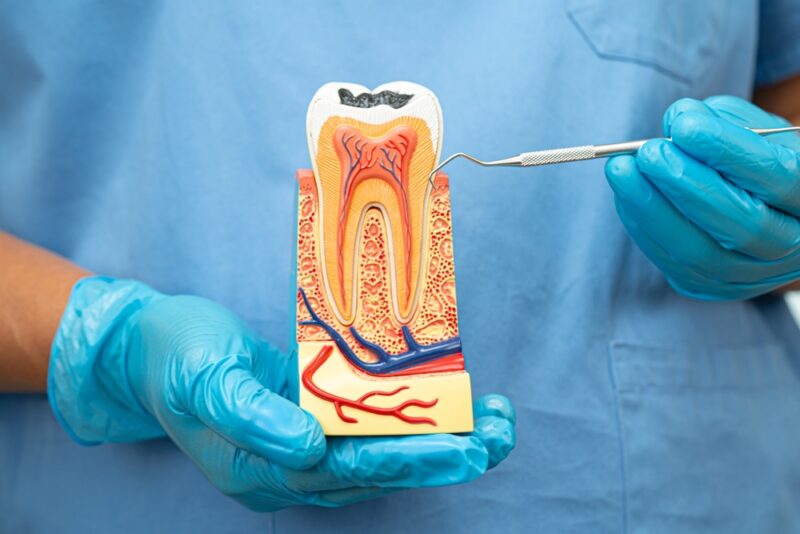 root canals el paso